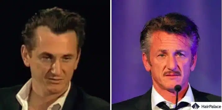 Sean Penn greffe de cheveux avant et apres