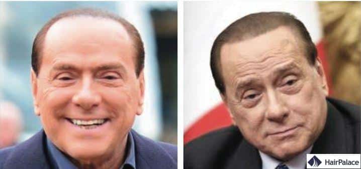 Greffe de cheveux Silvio Berlusconi avant et après