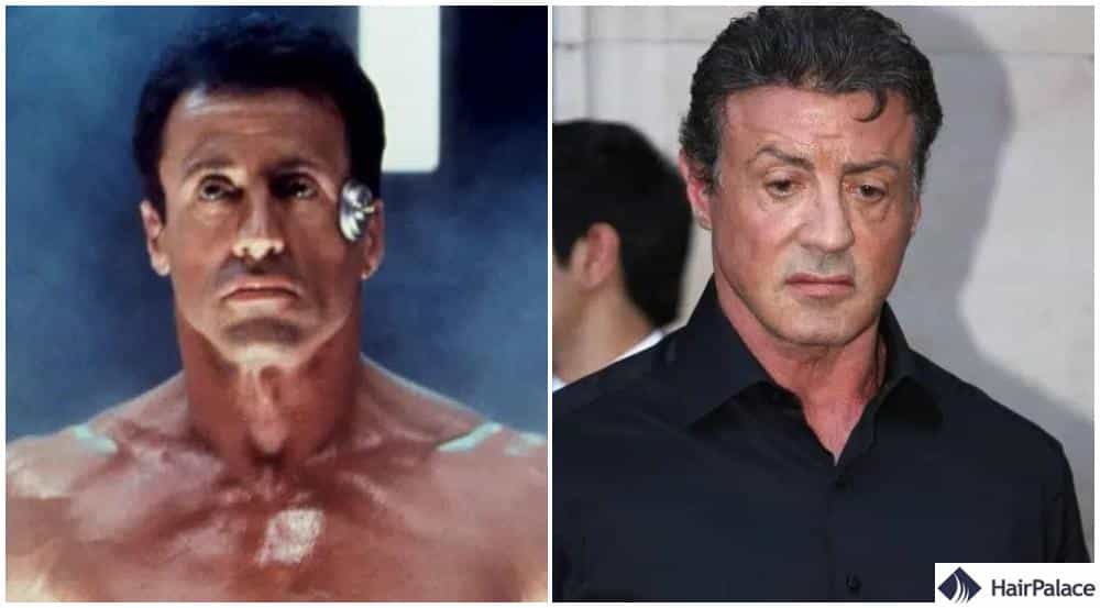 Greffe de cheveux Sylvester Stallone avant et après