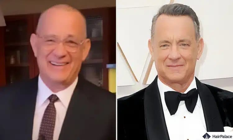 Greffe de cheveux Tom Hanks avant et après