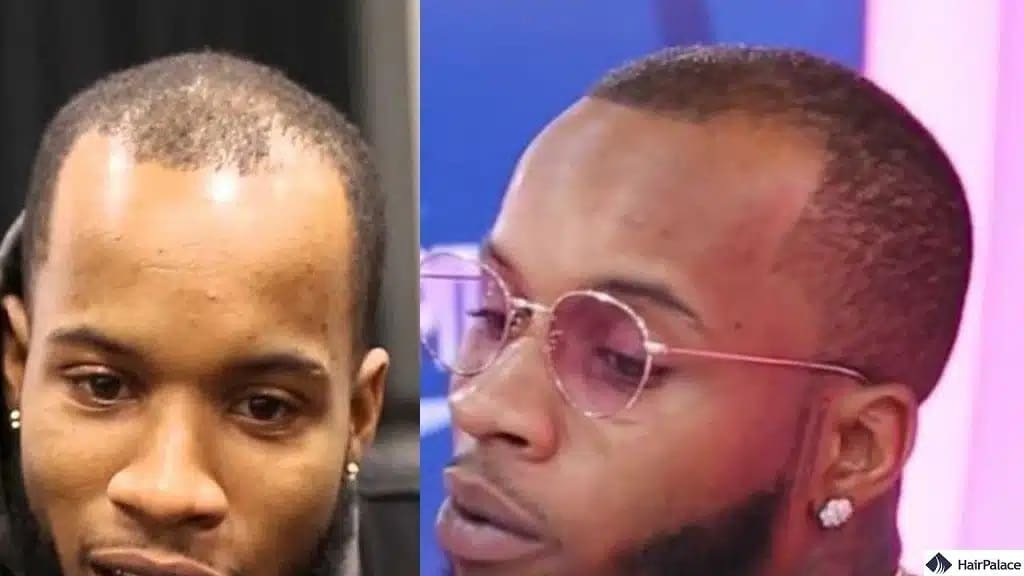 Greffe de cheveux Tory Lanez avant et après