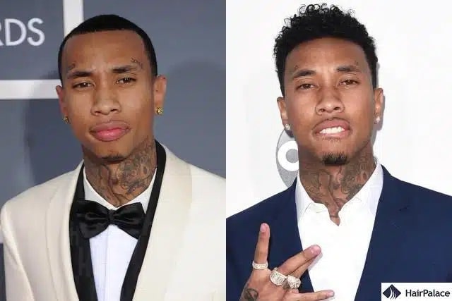 Greffe de cheveux Tyga avant et après