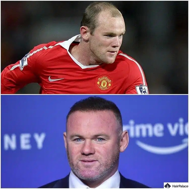 Greffe de cheveux Wayne Rooney avant et après