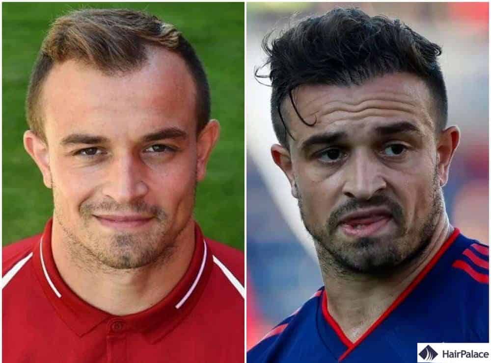 Shaqiri après la greffe de cheveux fue avec des mèches luxueuses