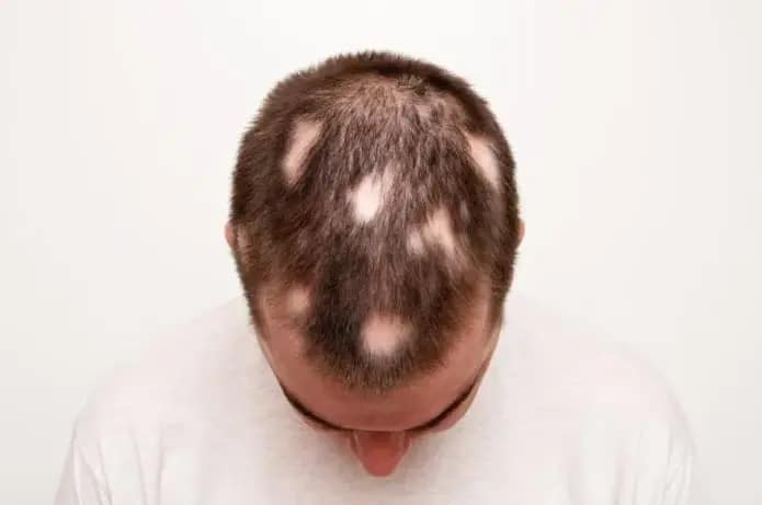 la pelade peut être une cause cuir chevelu qui gratte et perte de cheveux