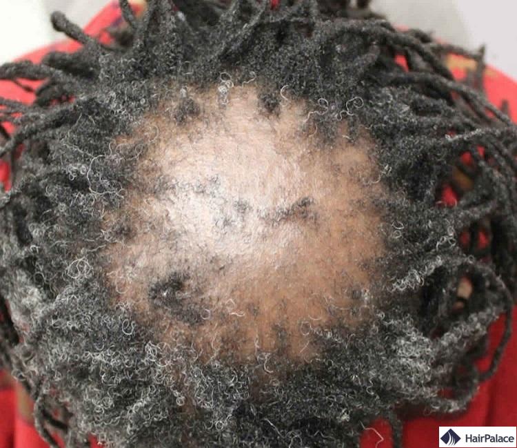 l'alopécie cicatricielle est une cause de perte de cheveux permanente