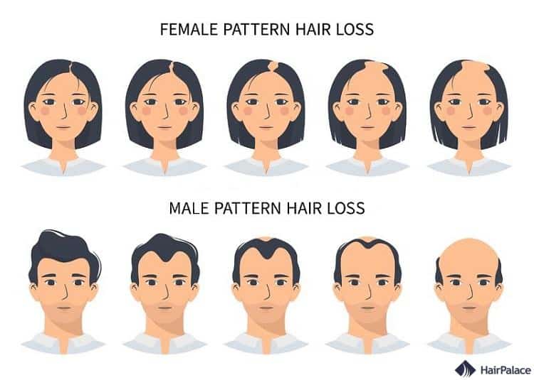 les différences entre la calvitie masculine et la perte de cheveux féminine