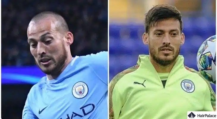 Greffe de cheveux David Silva avant et après