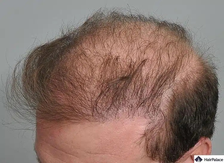 une greffe de cheveux ratée peut entraîner une mauvaise croissance des cheveux.