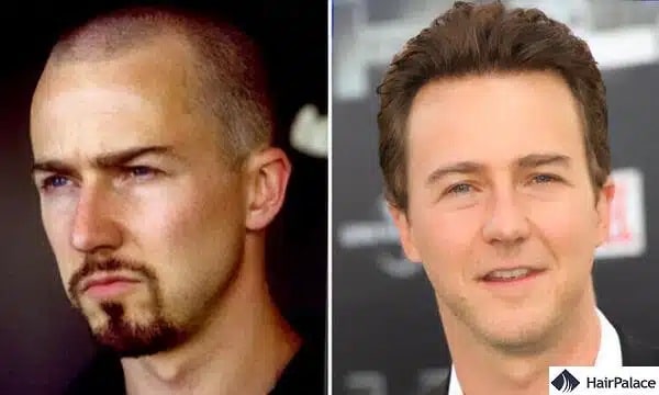 Greffe de cheveux Edward Norton avant et après