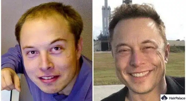 Greffe de cheveux Elon Musk avant et après