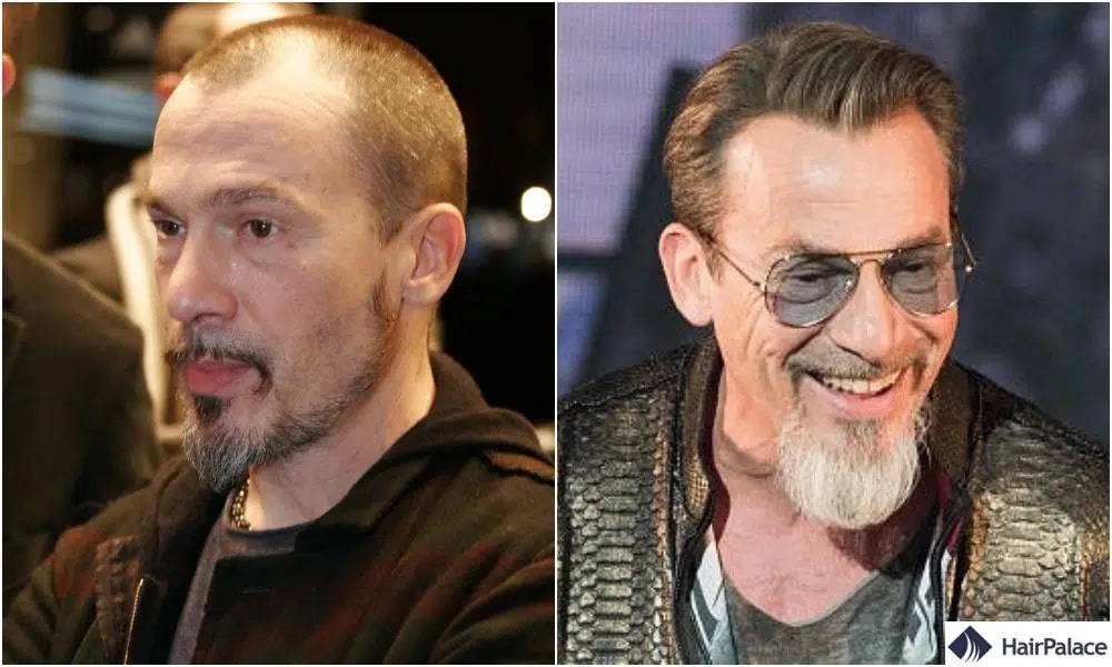 Greffe de cheveux Florent Pagny avant et après