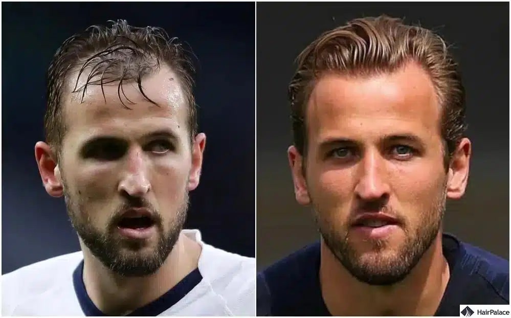 Greffe de cheveux Harry Kane avant et après