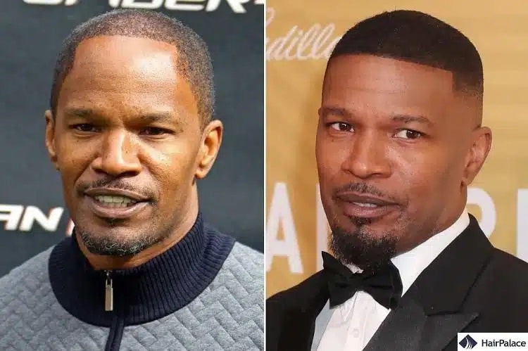 Greffe de cheveux Jamie Fox avant et après