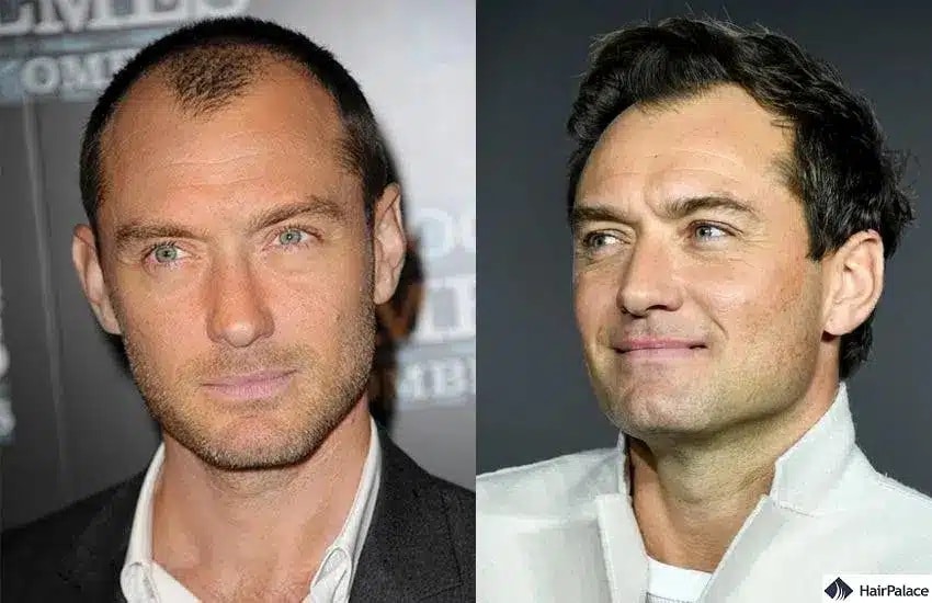 Greffe de cheveux Jude Law avant et après