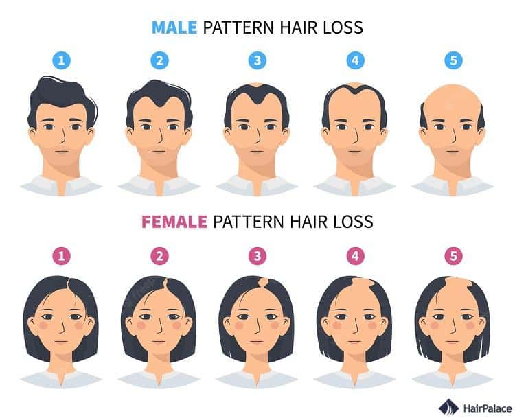 calvitie masculine vs perte de cheveux féminine