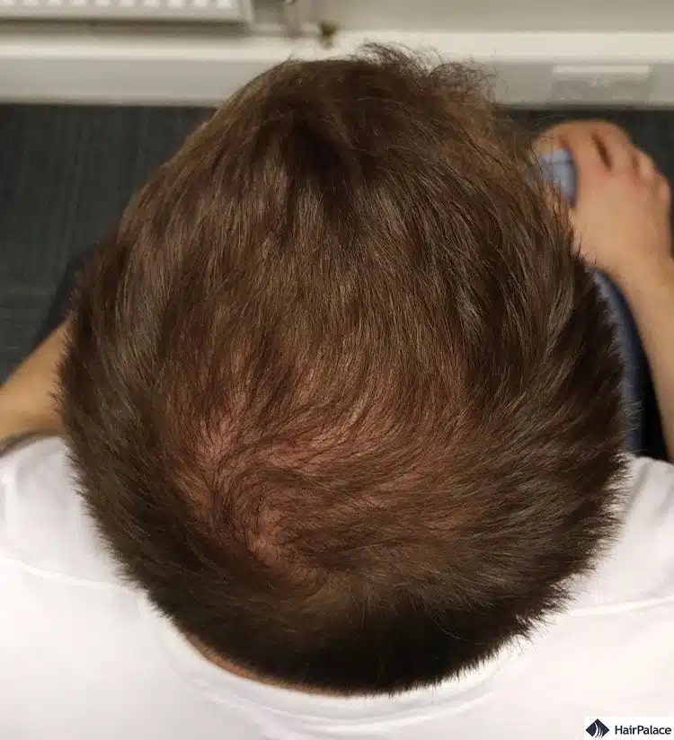 greffe de cheveux de couronne après 6 mois