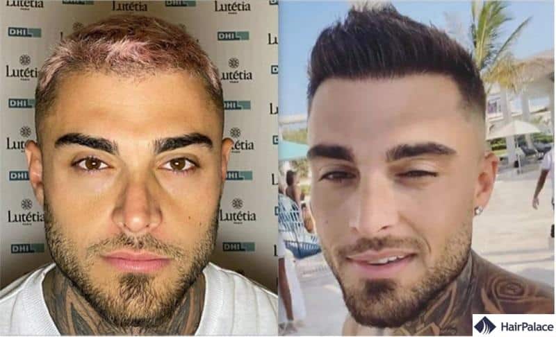 Greffe de cheveux Thibault Garcia avant et après
