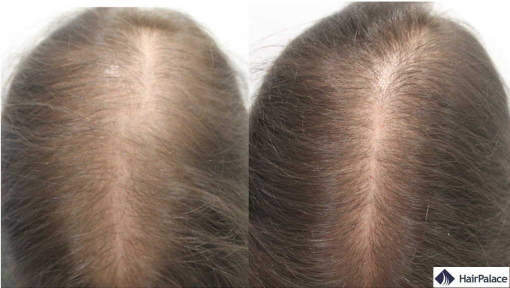 Le Finasteride Topique Pour la Perte de Cheveux