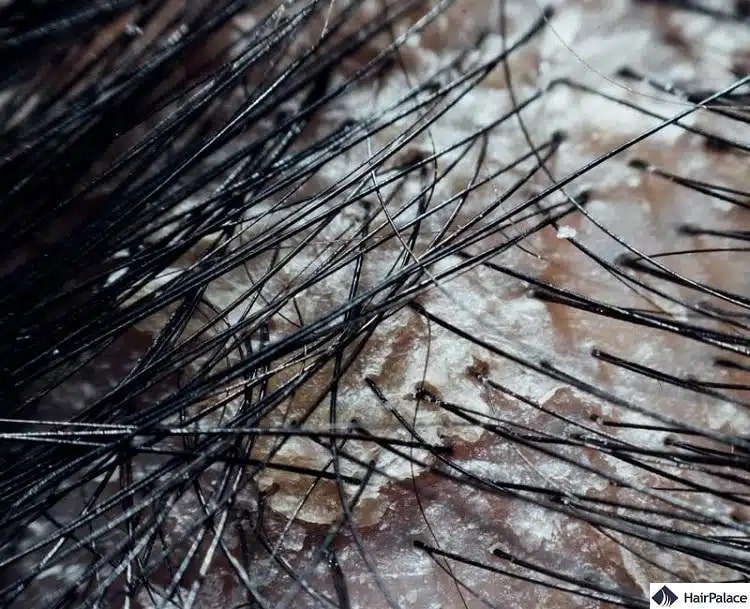 les pellicules peuvent causer cuir chevelu qui gratte et perte de cheveux