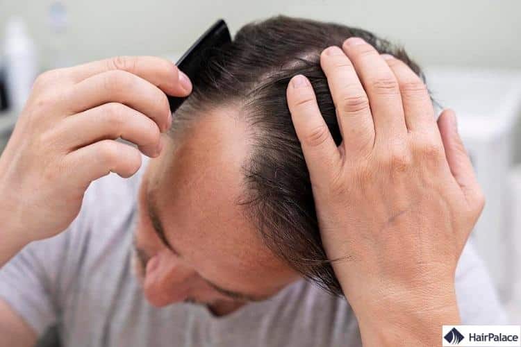 Le Finasteride Topique Pour la Perte de Cheveux