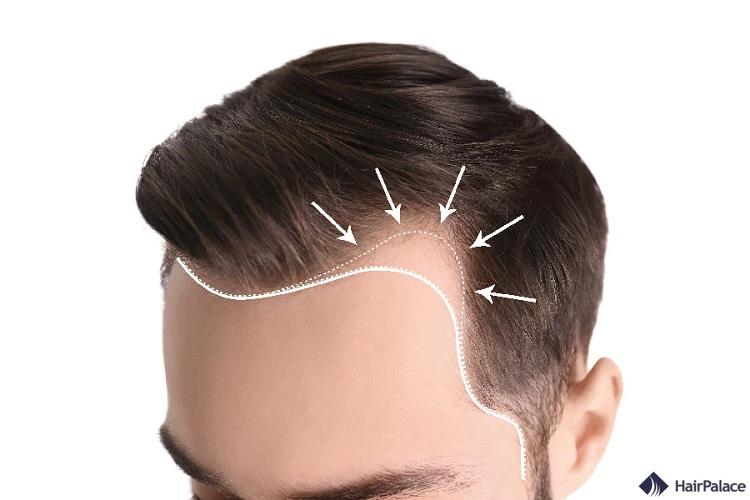La Greffe de Cheveux de la Ligne Frontale