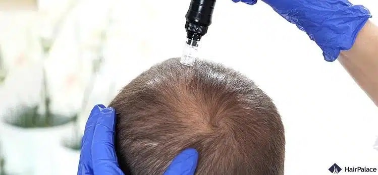 traitement microneedling pour la perte de cheveux
