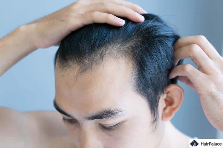 les premiers signes de perte de cheveux peuvent apparaître dans la vingtaine