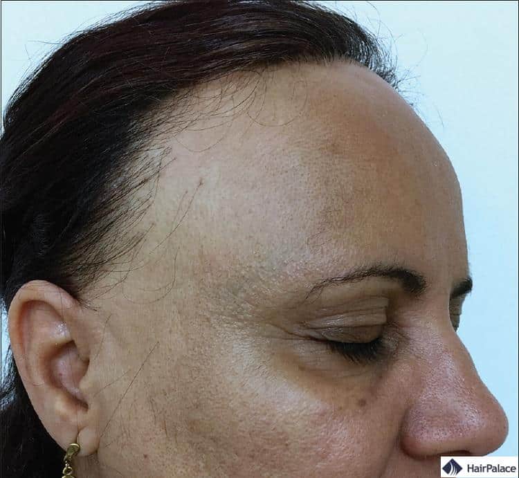 les symptômes de l'alopécie frontale fibrosante ressemblent à cette image