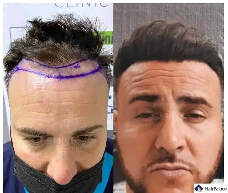 après une greffe de cheveux en Turquie