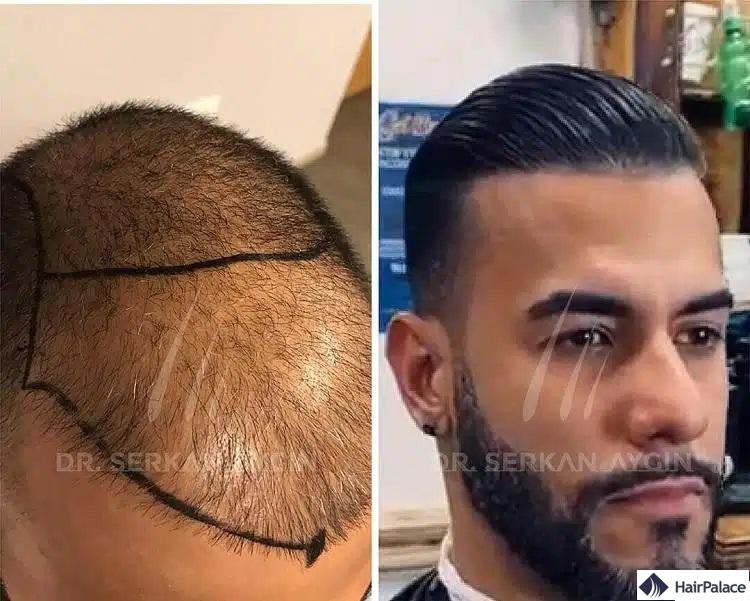 une greffe de cheveux en turquie