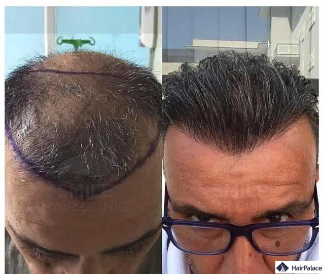 avant et après la greffe de cheveux