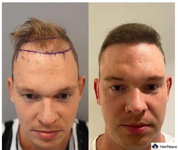 avant et après la greffe de cheveux en Turquie