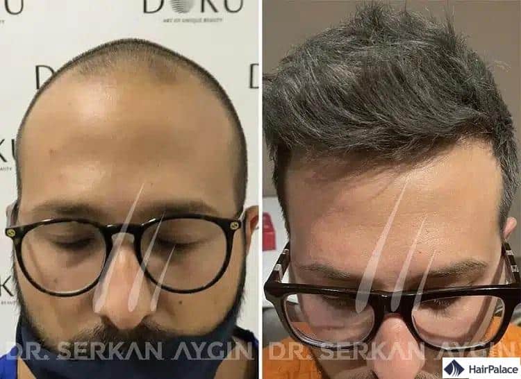 Résultats de la greffe de cheveux en Turquie