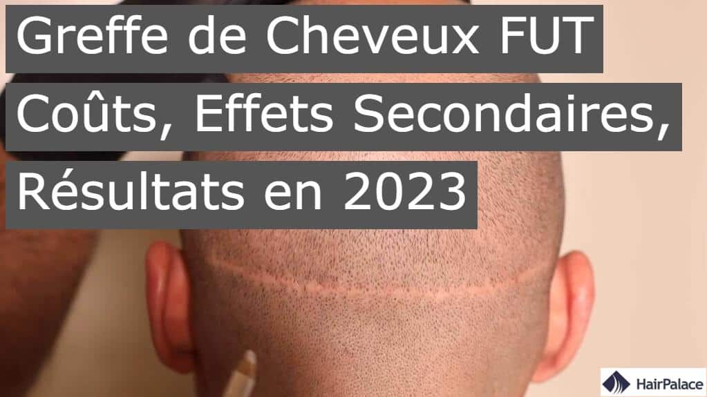 Greffe de cheveux FUT Couts effets secondaires resultats en 2023