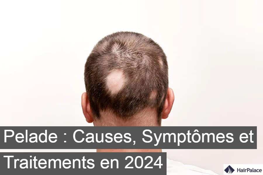 Pelade  Causes, Symptômes et Traitements en 2024